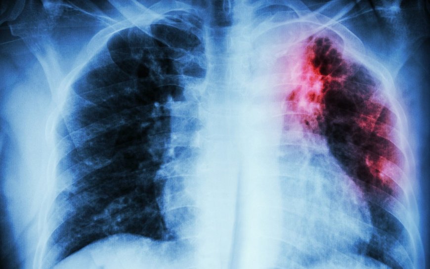 Tidak Semua Orang Terinfeksi Kuman TBC Mengalami Gejala Sakit